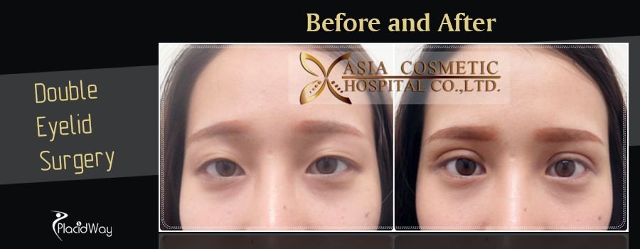 Before and After Double Eyelid Surgery in Thailand